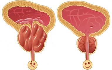 How Prostalix works in prostatitis before and after treatment