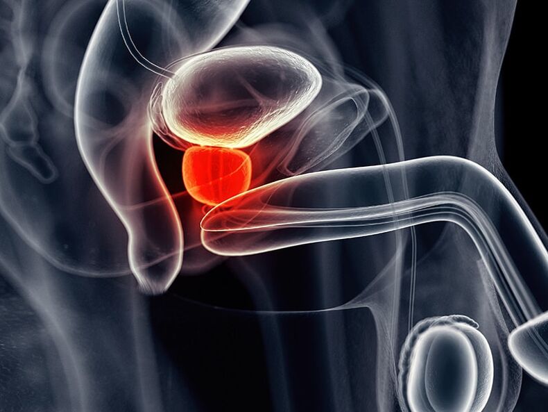 Prostatitis accompanying chronic prostatitis