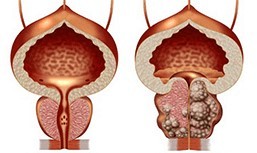 A healthy and an unhealthy prostate