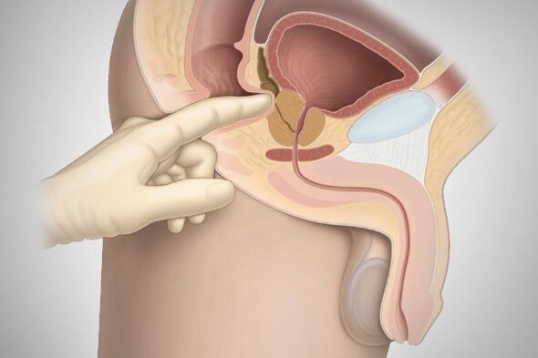 Prostate massage in bacterial prostatitis