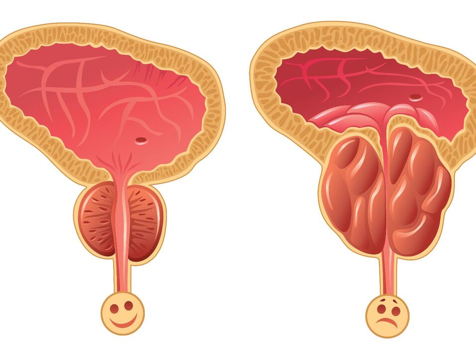 Healthy prostate and prostate congestive prostatitis