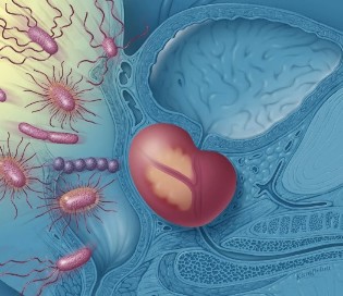 An inflammation of the prostate gland
